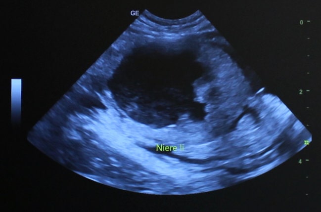 Ultraschall veränderte Niere